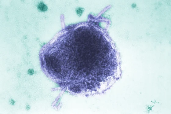 Los Angeles Child Dies From Rare Measles-Linked Brain Disorder